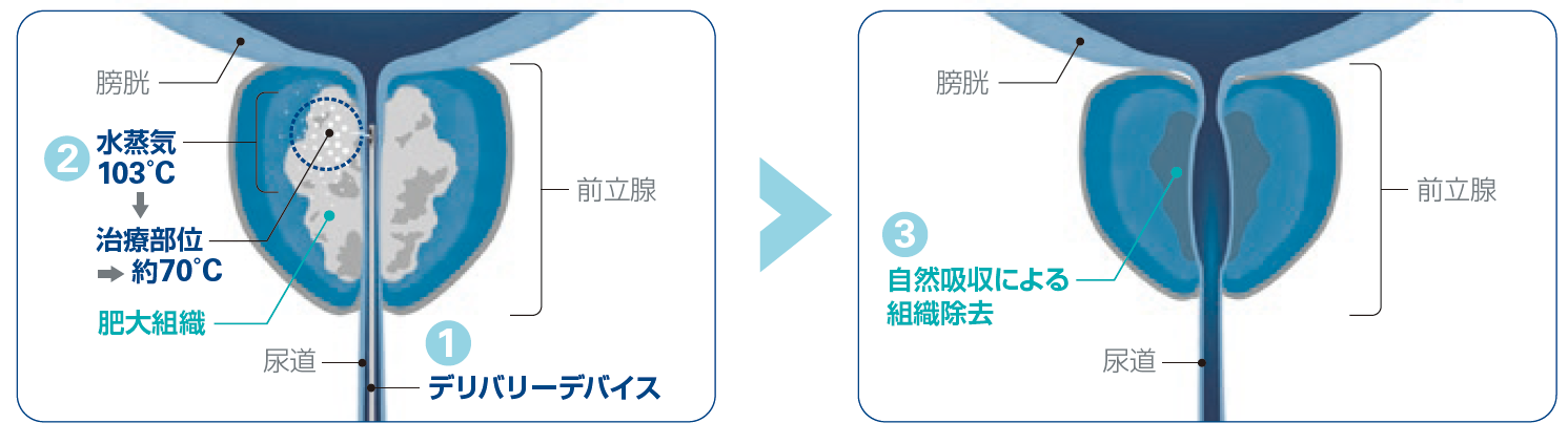 水蒸気治療の仕組みを示した前立腺の模式図